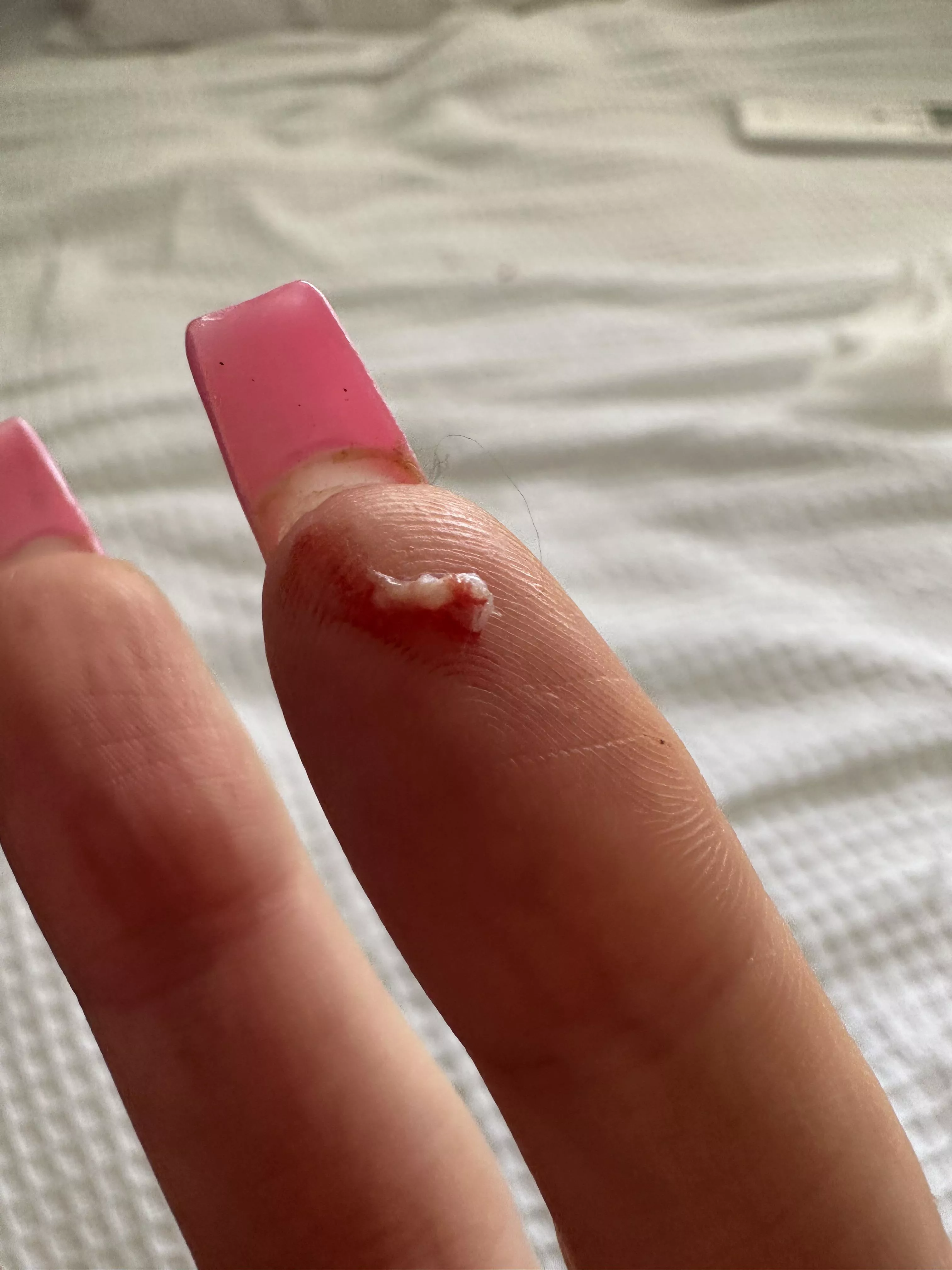 Finally popped a painful ingrown hair in my pubic region 😅 wish I got a vid! posted by pamDiaze