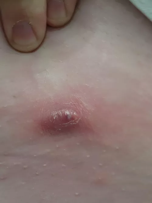 I really hate my body sometimes... angry boil right on my waist line. Tylenol for swelling, but if it doesn't go down by tomorrow, I'm seeing a doctor. by Essrysam