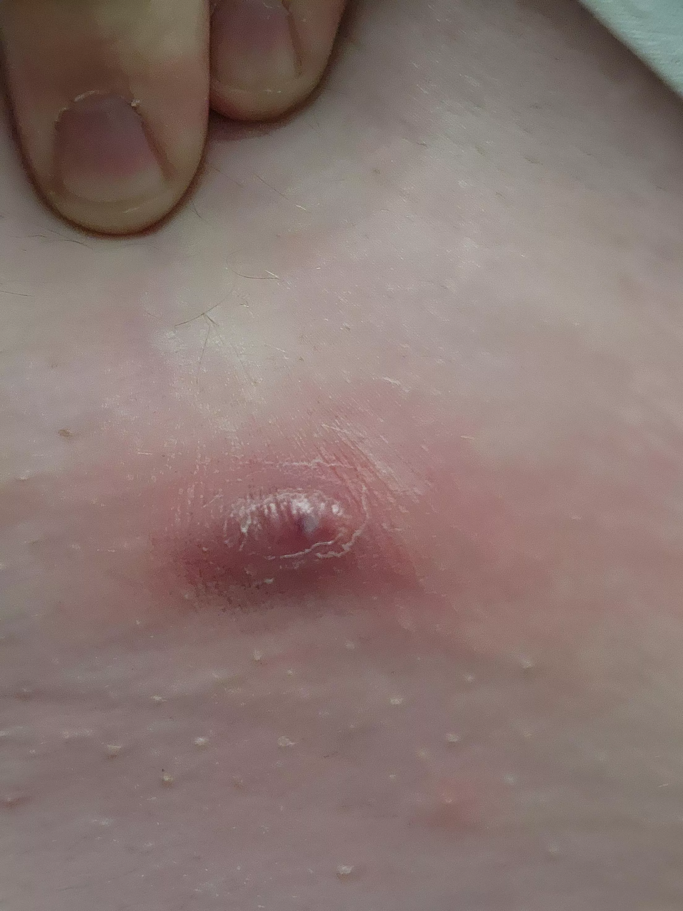 I really hate my body sometimes... angry boil right on my waist line. Tylenol for swelling, but if it doesn't go down by tomorrow, I'm seeing a doctor. posted by Essrysam