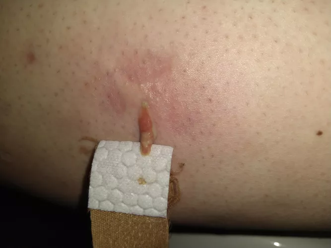 I'm getting sick and fuckin tired of these ingrown hairs. I'll be having my first laser hair removal appointment for my legs end of this month. Seemed to have helped with my face. by Trichter_NET