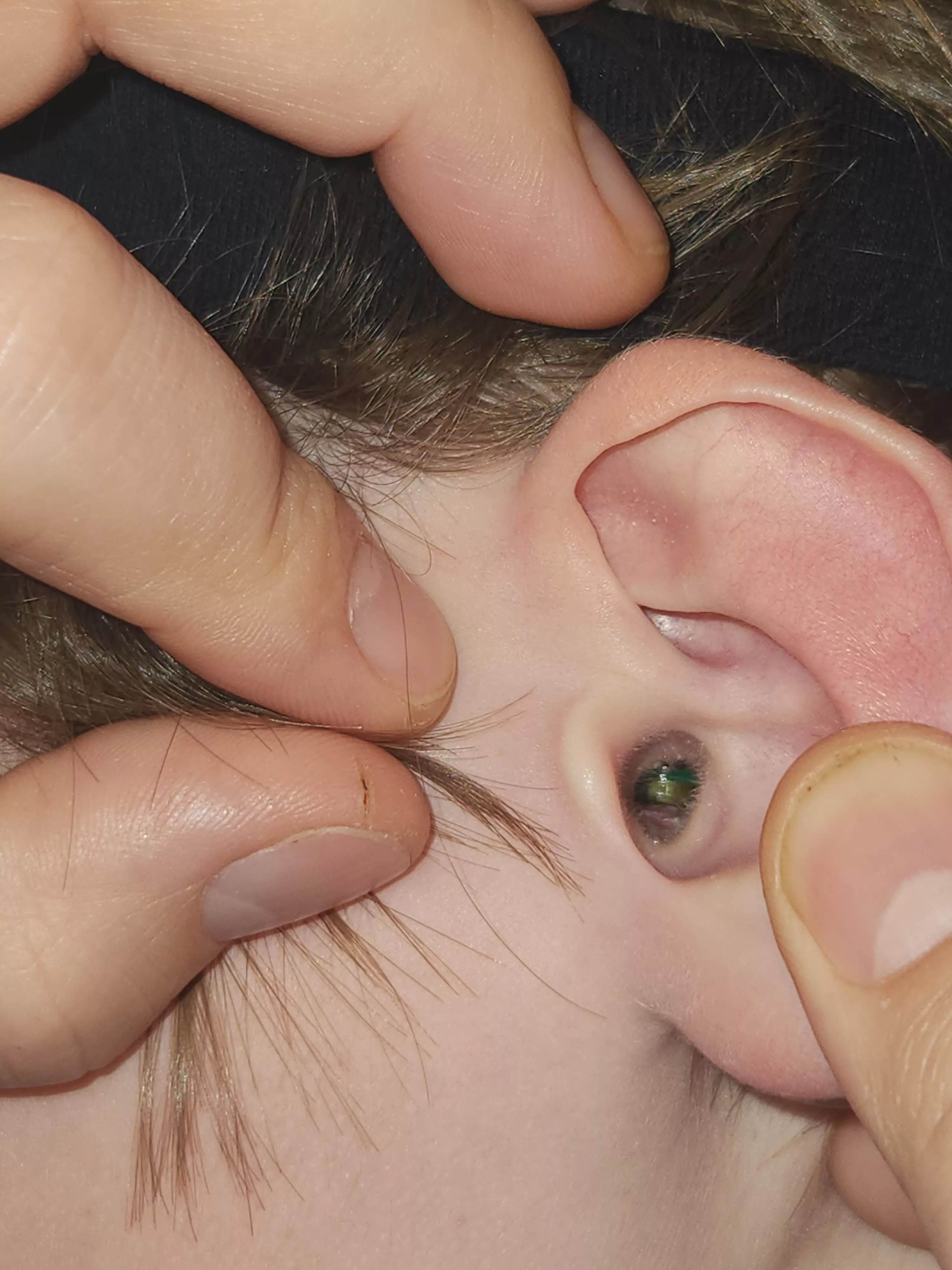 Let's try this again... My son has had a lego on his ear for 3 years... posted by booksimonriverwash