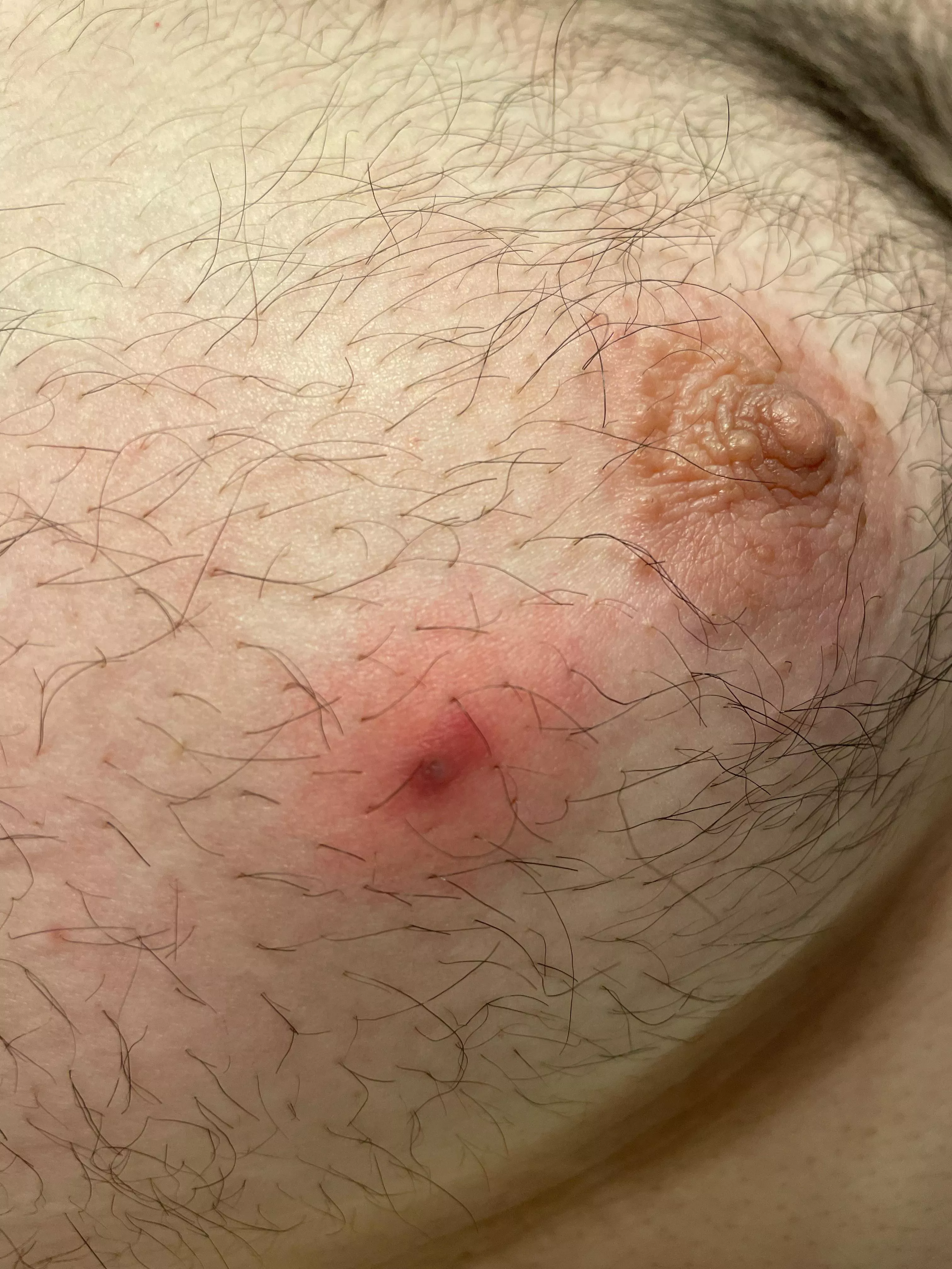 Nast ingrown hair on my chest, waiting for it to come to a head posted by Cananbaum