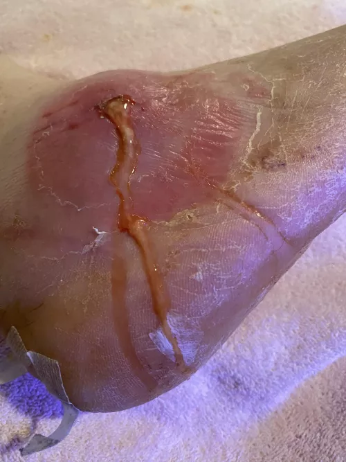 Post Surgery… figured y’all would appreciate it. Enjoy! by SpectreRSG