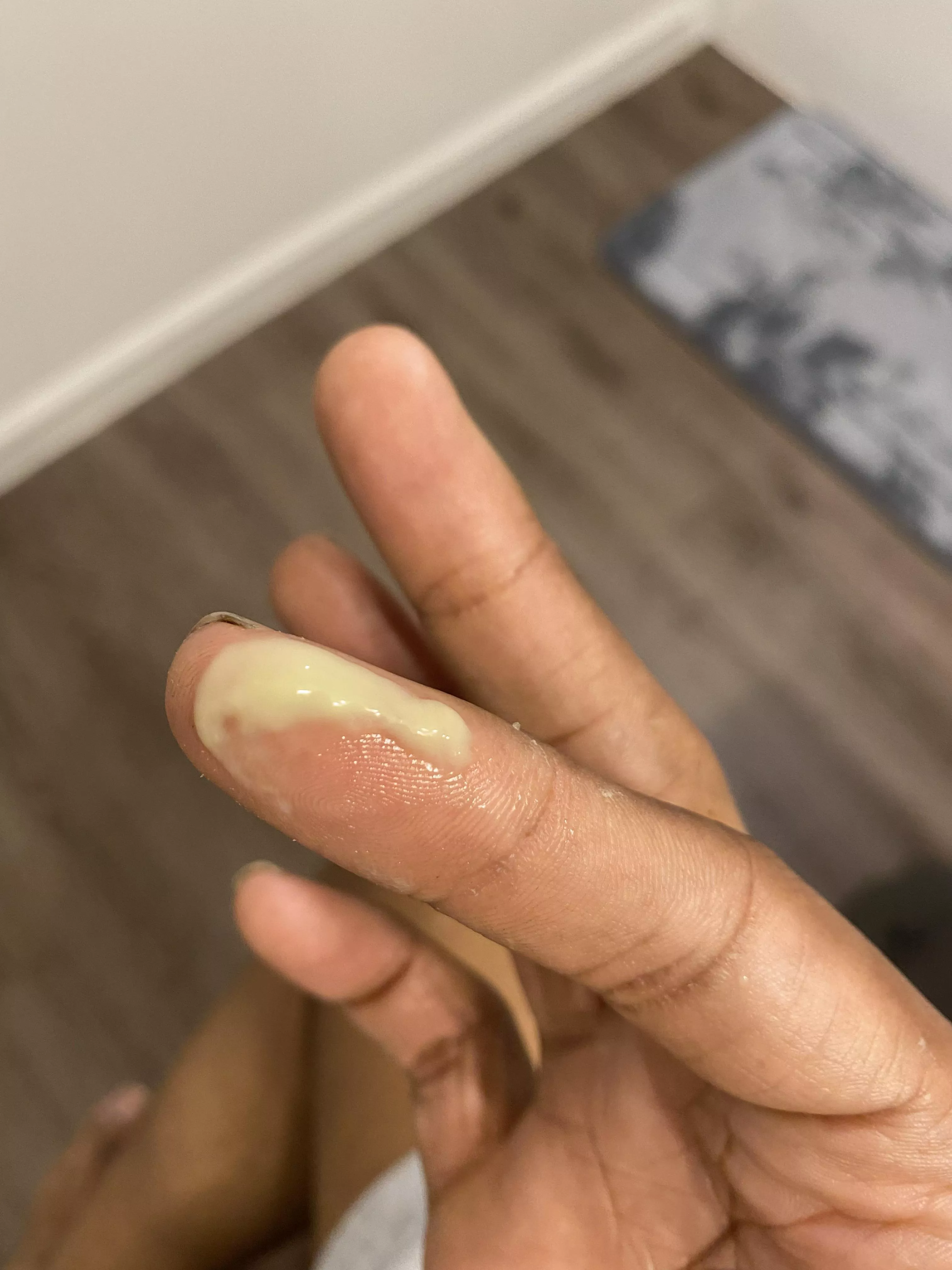 So this is what I go through with Dissecting cellulitis posted by mnixon03