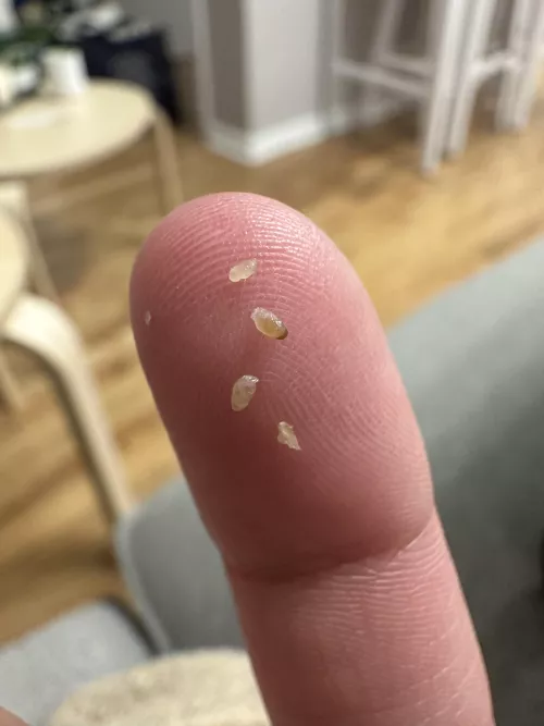 chest blackheads…. iphone 14 zoom goes crazy by possumanatomy