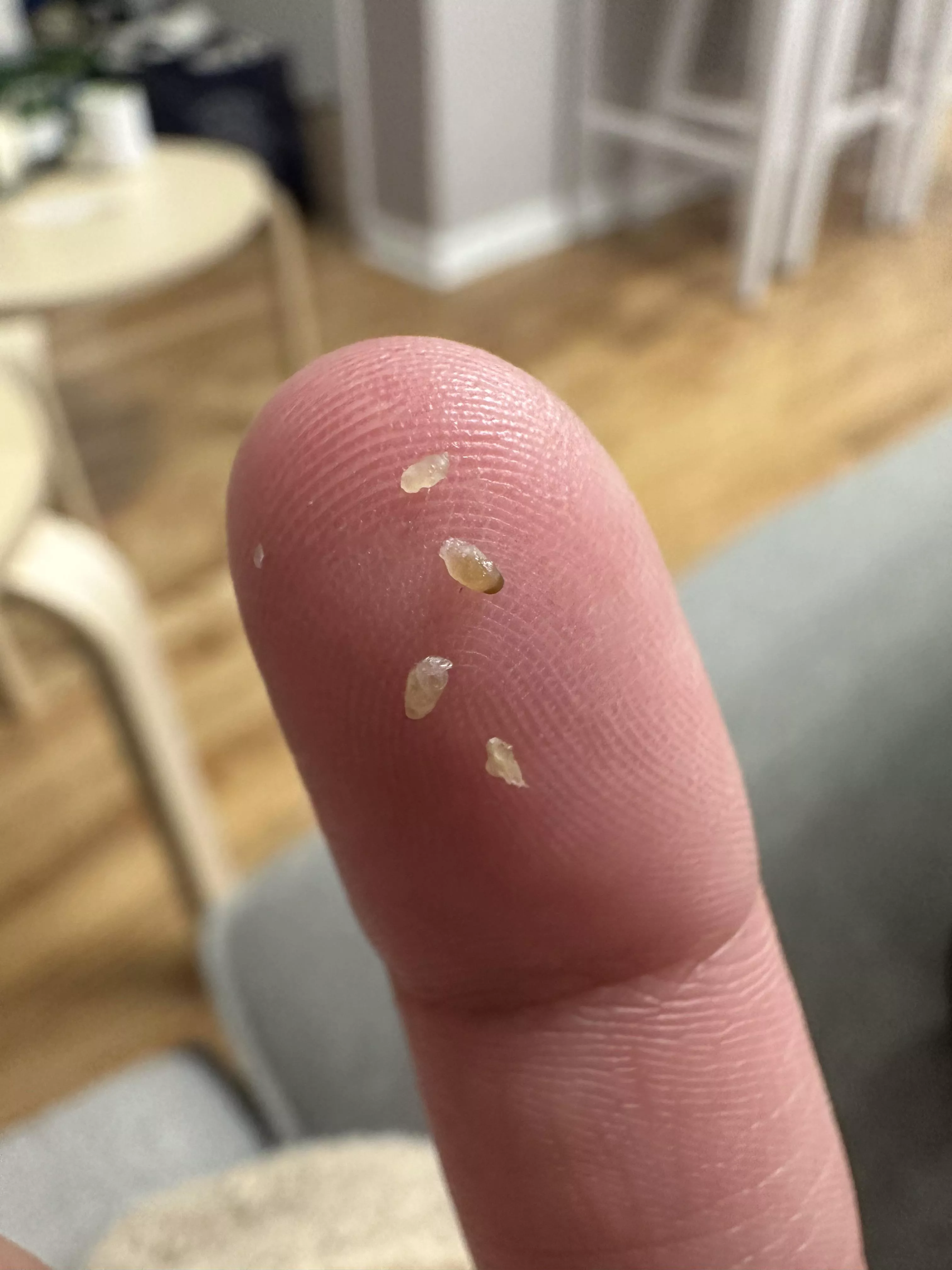 chest blackheads…. iphone 14 zoom goes crazy posted by possumanatomy