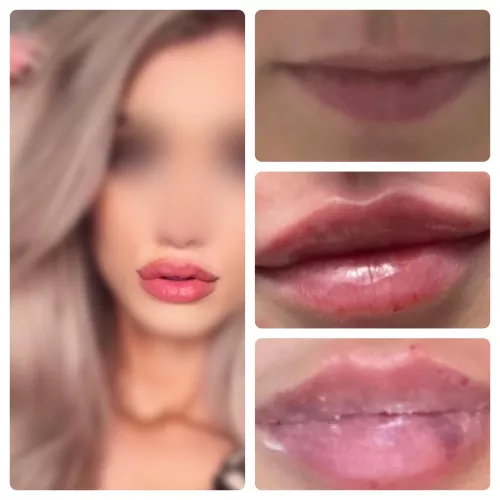 Third round of lip fillers booked! Hoping for the perfect bimbo pout! by UrbanRivals123