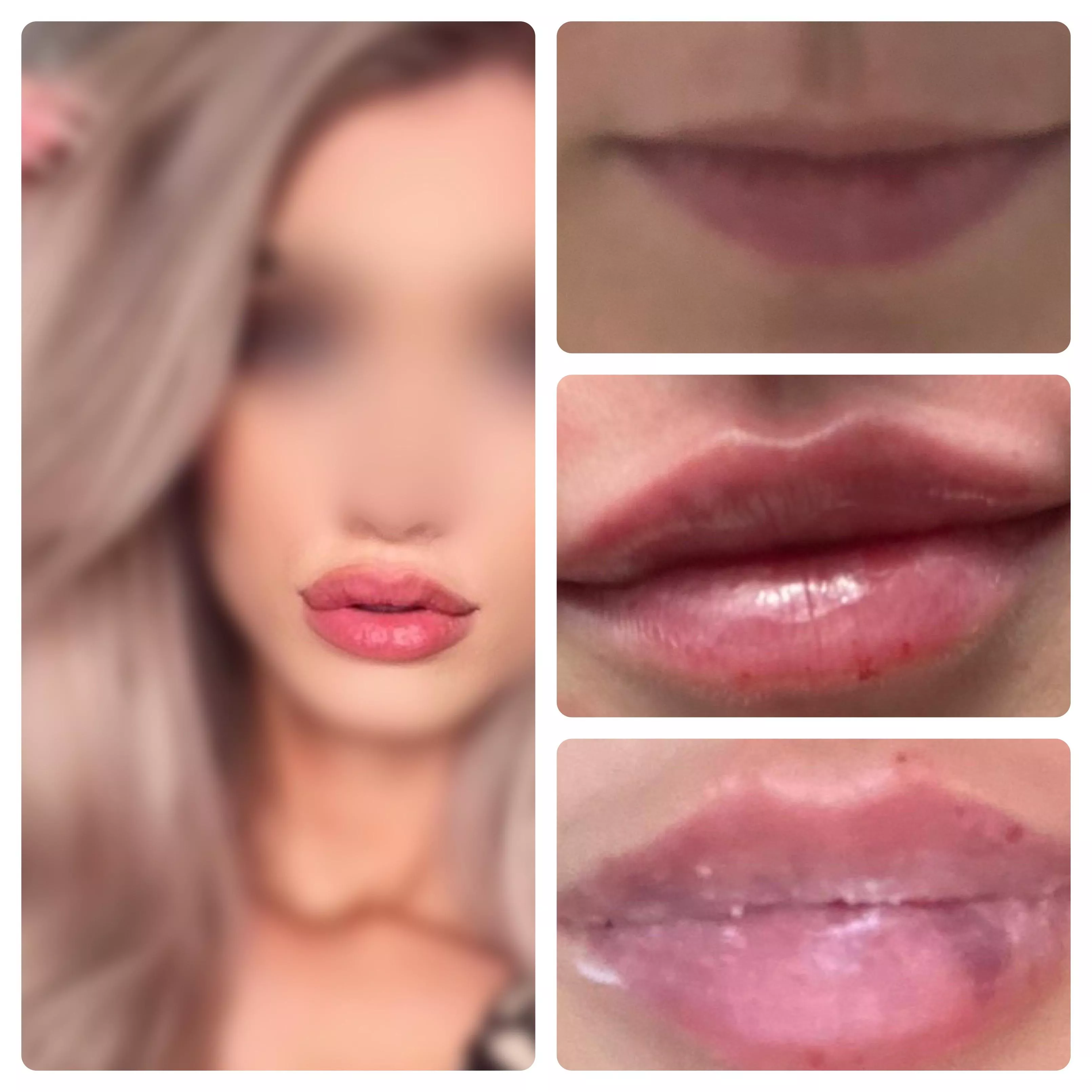 Third round of lip fillers booked! Hoping for the perfect bimbo pout! posted by UrbanRivals123