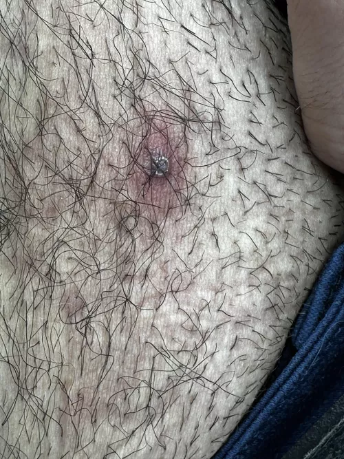 What’s this and should I go for popping it? It hurts touching it too (it’s under my belly button) by TroyExplores