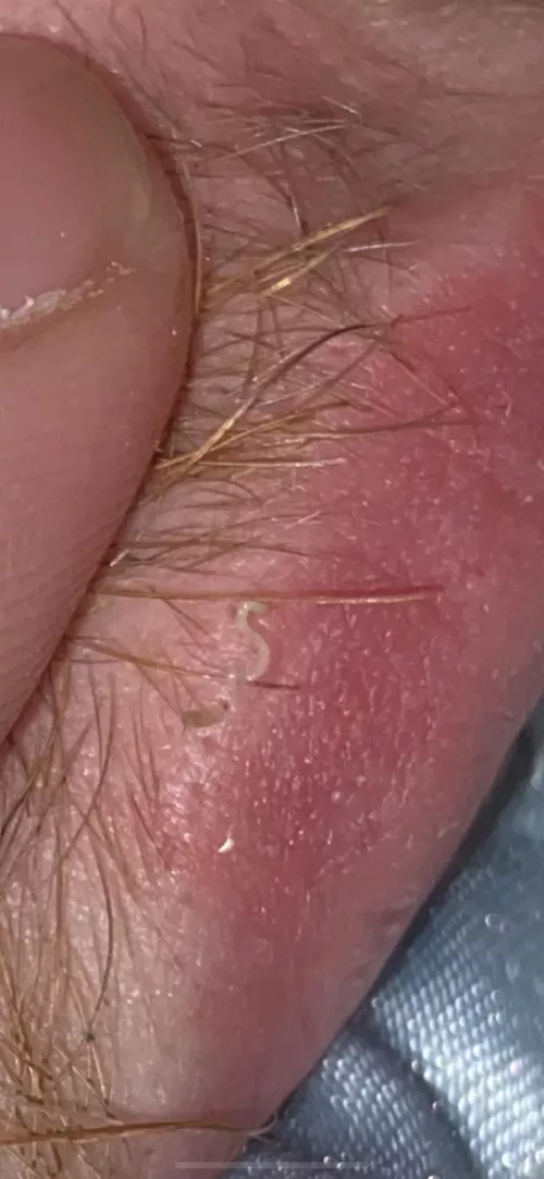 first time poster. 2 distant cousins i squeezed out of my boyfriends lip. by deadmannerisms