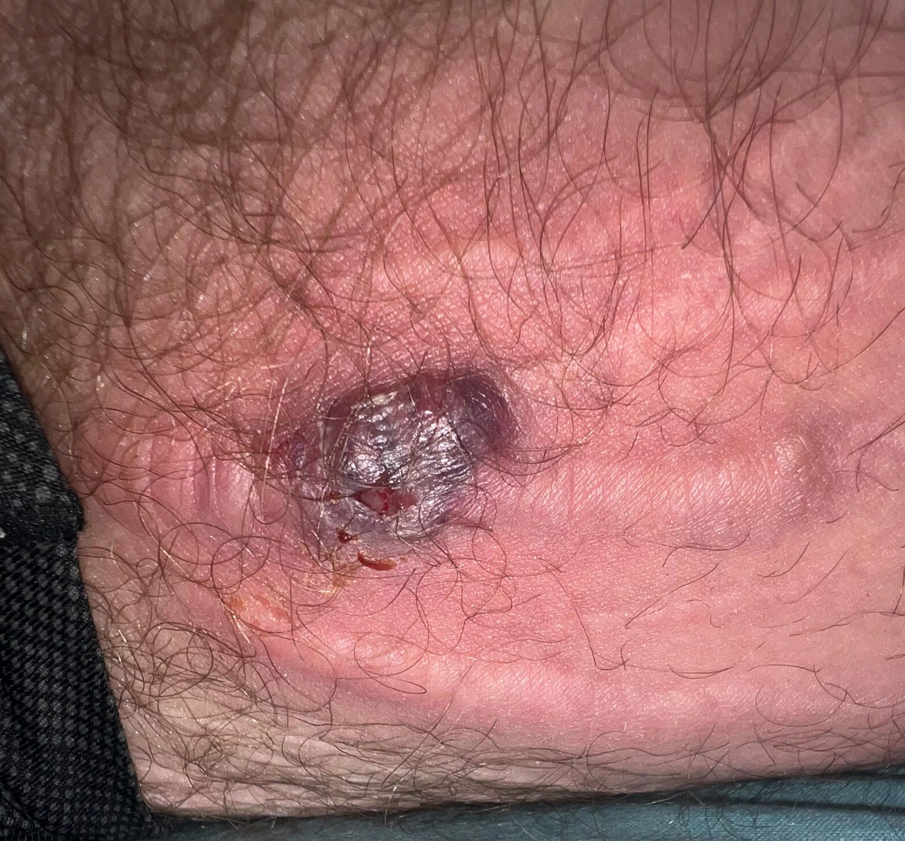 Swollen cyst/pimple on stretch mark, hurts like hell. Any idea what it might be? posted by bakeable