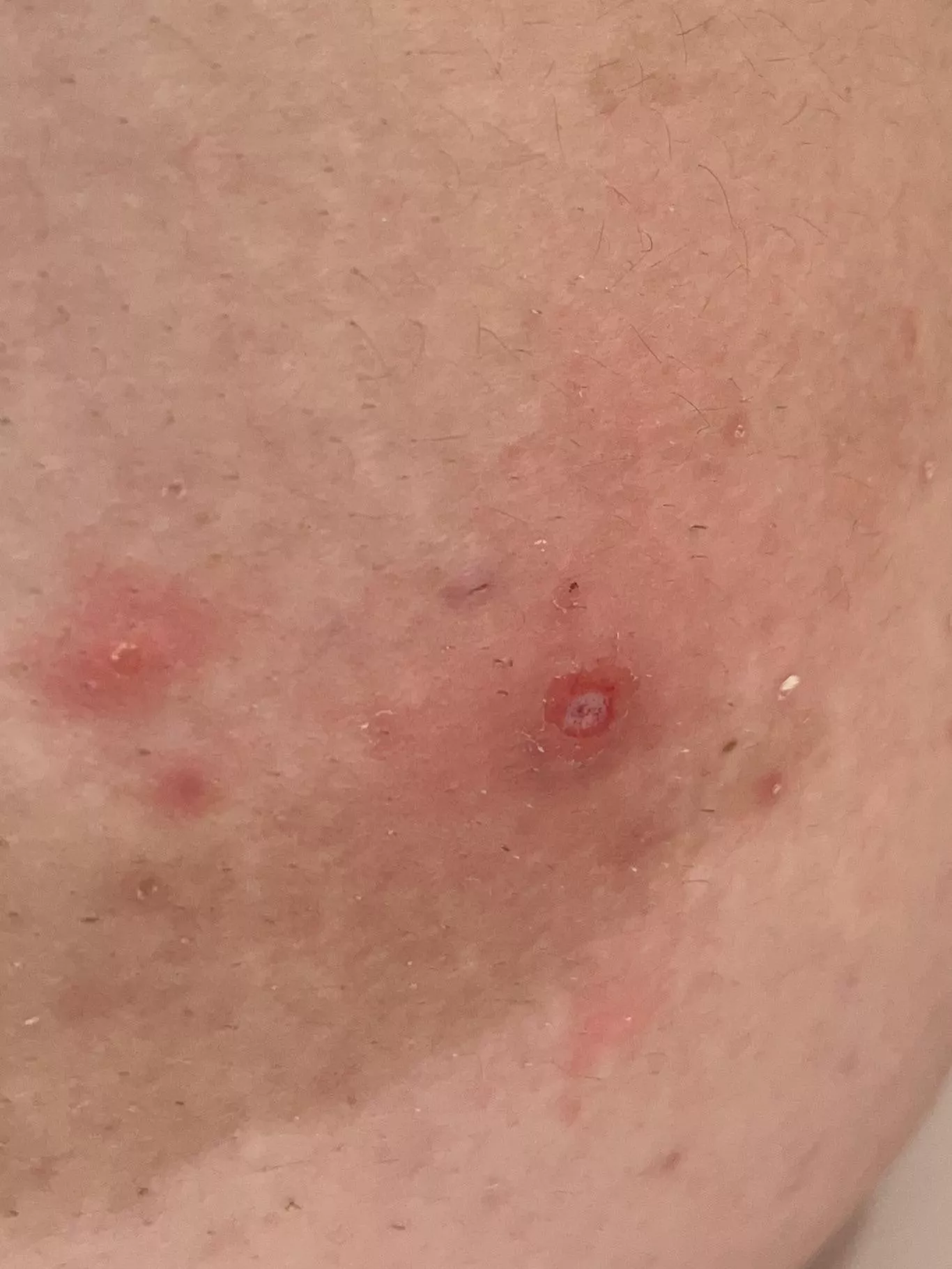 Popped a pimple, left this narly hole after a few weeks of picking at it the scab. posted by Own_Substance_1432