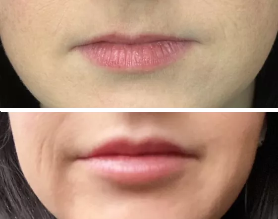 Wife's first lip upgrades. What do you think? posted by OneSection2628
