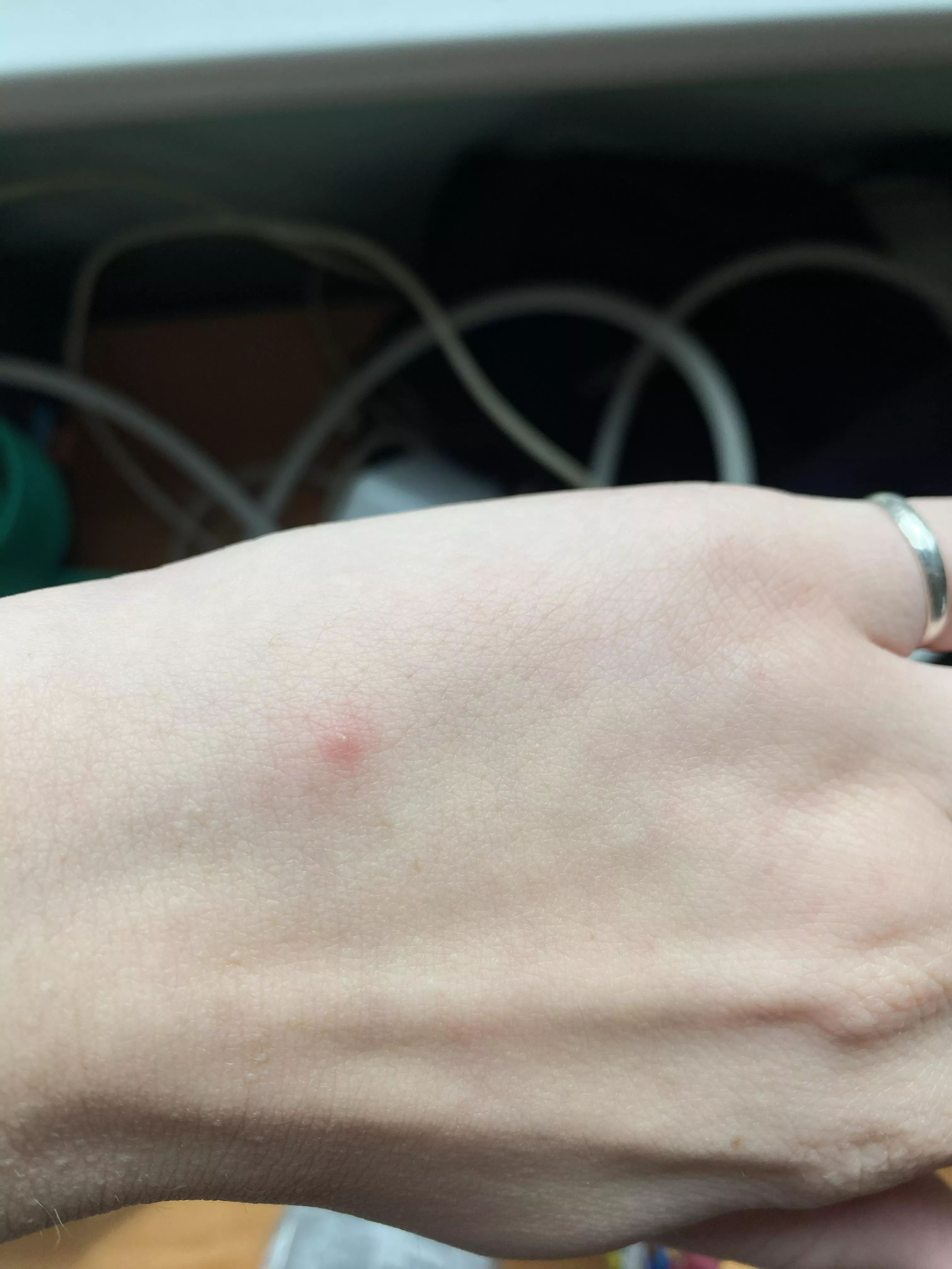 Bite? Pimple? Rash? I don’t even know what this is but I’m so tempted to pick at it! posted by chailatte731