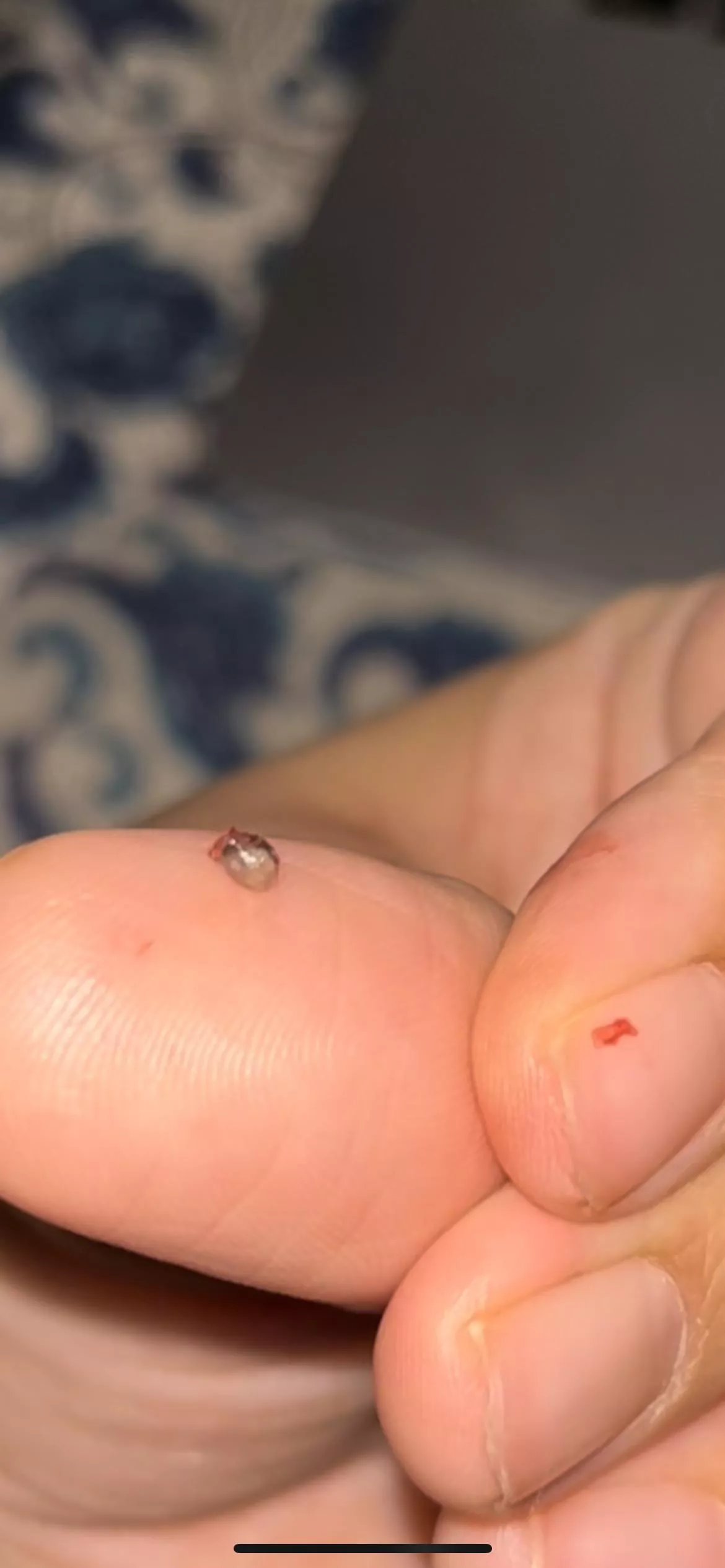 Had a pimple in my back for about 2 weeks, had no idea this had been growing inside. It is hard AF, exactly like a weed seed. Any idea how it could’ve become this way? posted by StonedNinja101