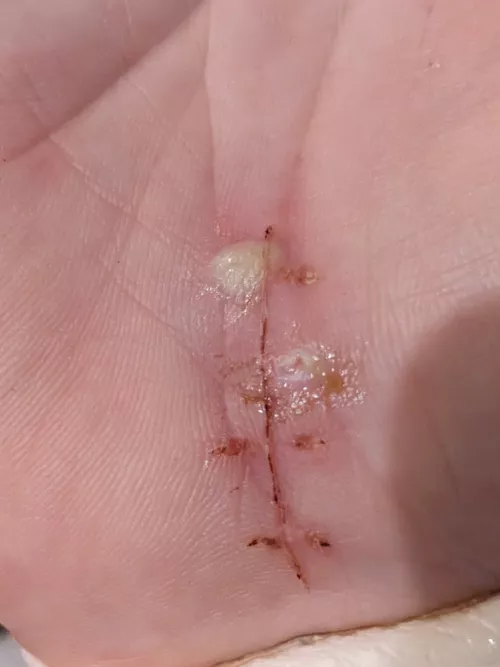 Forbidden Pop - Stitch Abscess. OC by wetdogsmell10