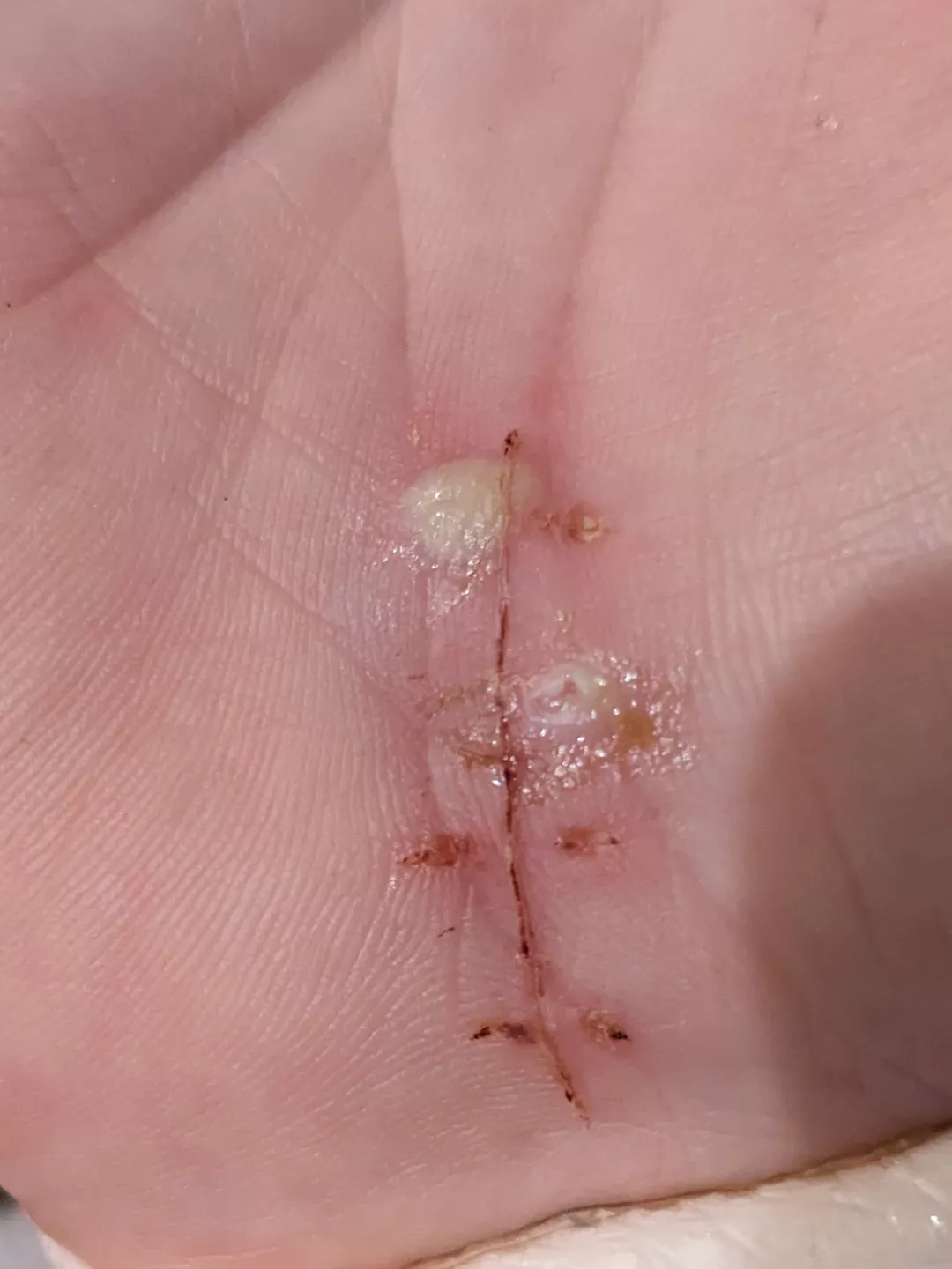 Forbidden Pop - Stitch Abscess. OC posted by wetdogsmell10