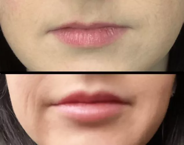 Wife got her first lip upgrades. How do they look? by OneSection2628