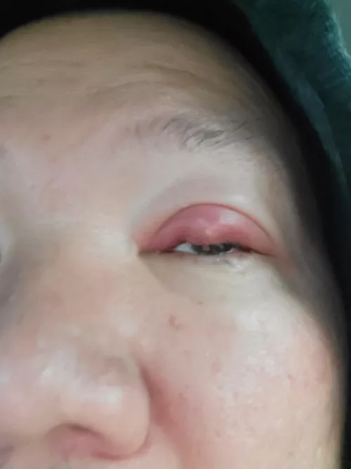 wish I could pop it. the pressure is painful! headed to doctor now by InevitableDisaster75