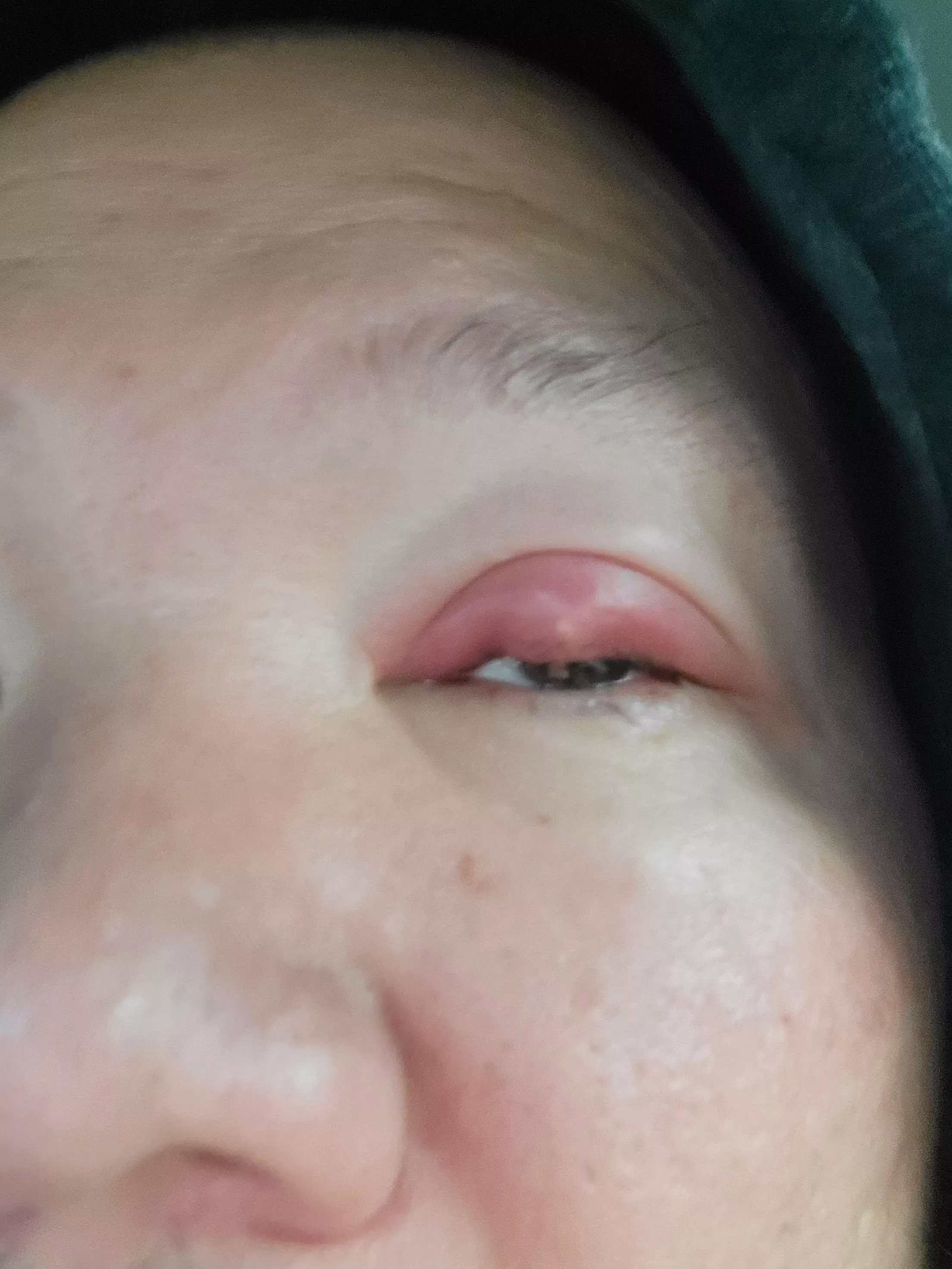 wish I could pop it. the pressure is painful! headed to doctor now posted by InevitableDisaster75