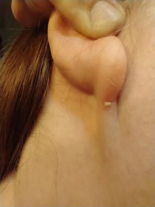 felt some soreness, gave a curious squeeze, was rewarded with a small gunk blob by lizardingloudly