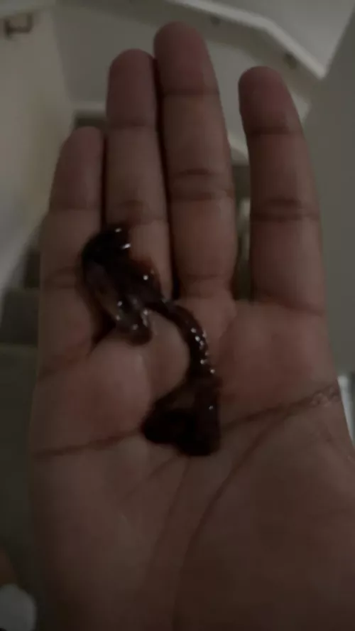 Massive blood clot from bose by chiiiitty