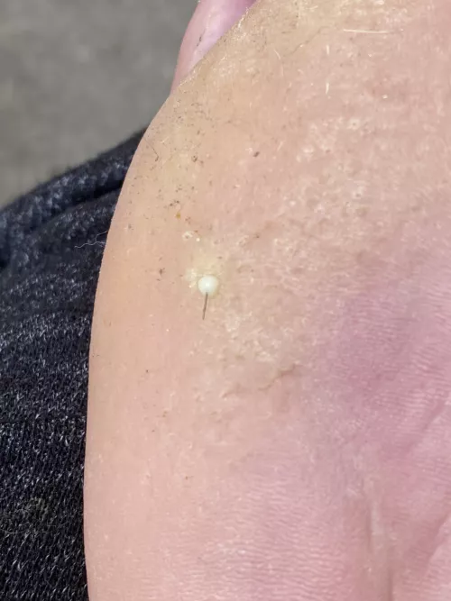 Had a saw spot underfoot. Was very surprised that a gentle squeeze produced this! by mingstaHK