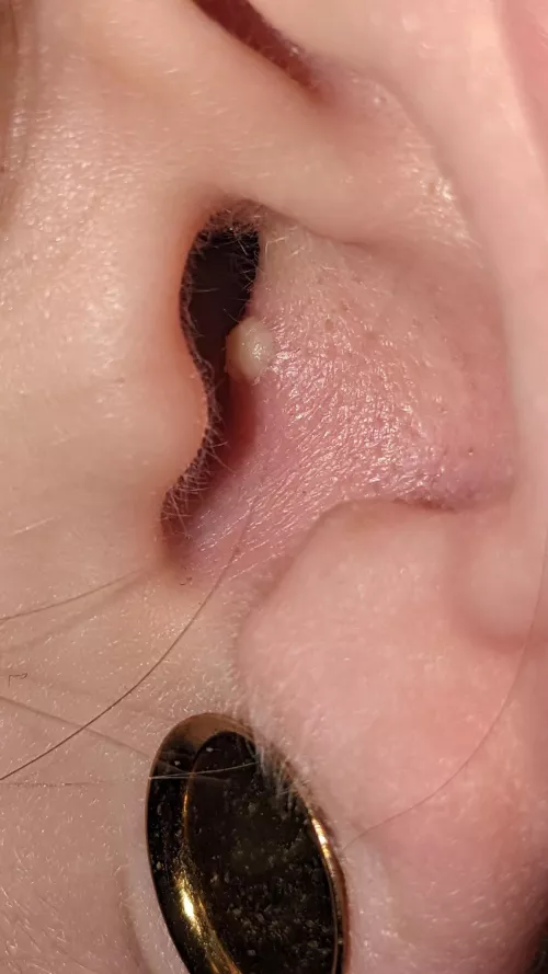 I’ve never had an ear pimple before I hate it by Specialist-Share69