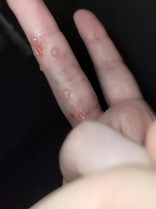 eczema flare up. will probably rupture in my sleep :( by ElyssaLaurelin