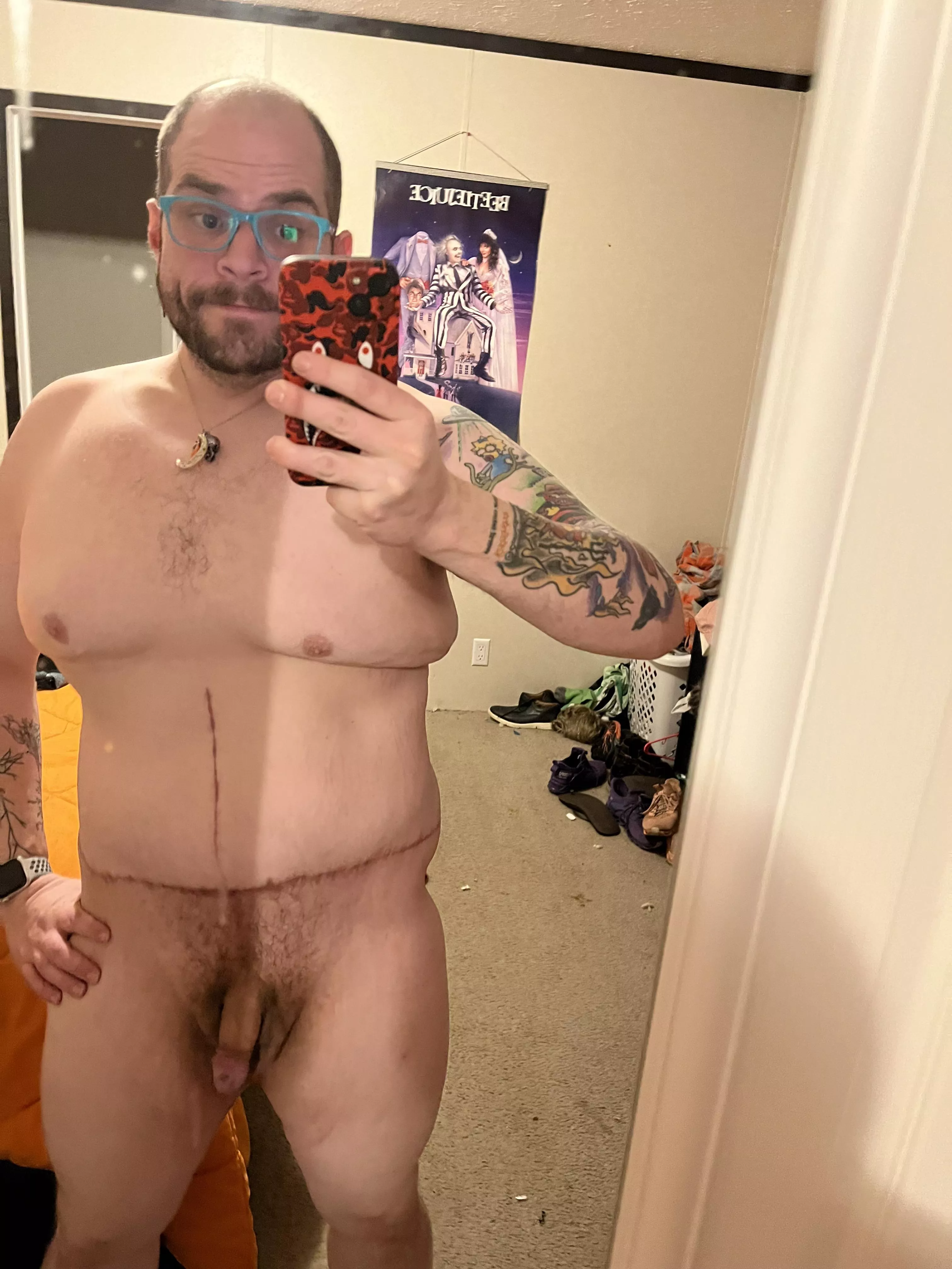 First nude since skin removal posted by Embarrassed_Prompt99