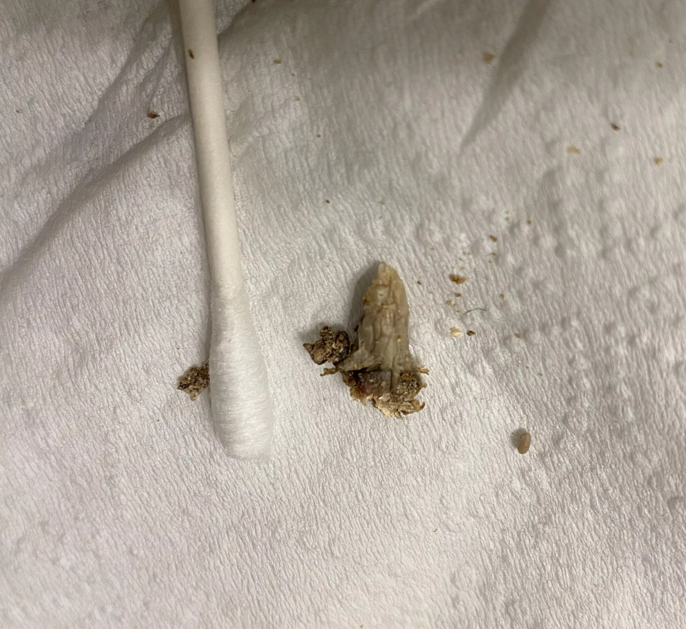 I thought my belly button was clean until I realized how deep the canal went…. After days of trying to reach it with tweezers and breaking off some pieces, I finally pulled out the rest of this 30 year old belly button stone. posted by blueghostcity
