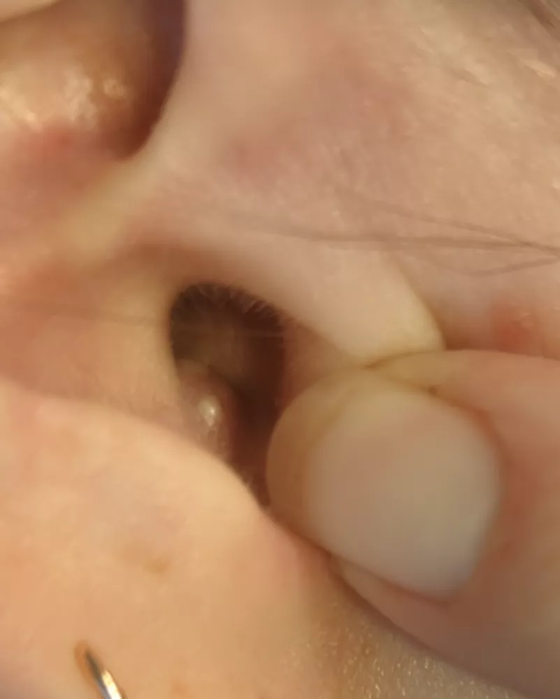 Double-headed inner ear pimple. Husband has been waiting to pop it for me. I can't wait any longer! posted by plantstudy37