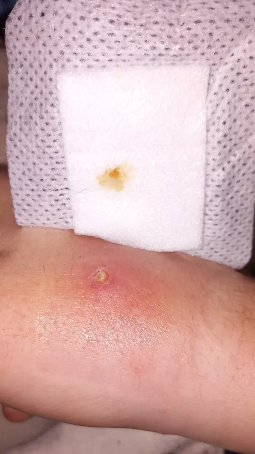 Forbidden pop (I'm on antibiotics & seen a doctor) by mudinyourear