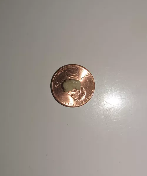 four score and 7 minutes ago I coughed out this tonsil stone by nibbles0