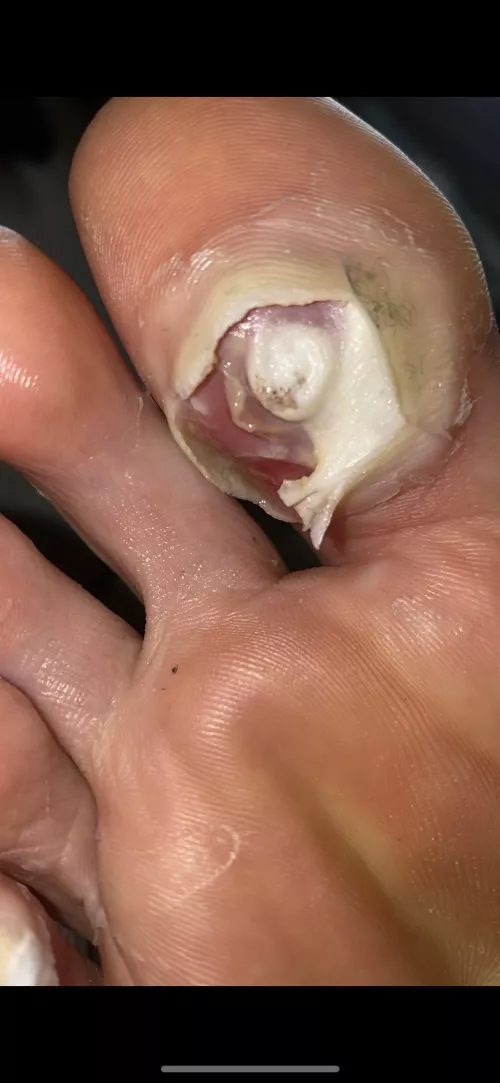 Plantar wart blister popper exposing the inner goodness of the raw wart - any ideas on how to proceed? by MartinMinkardo