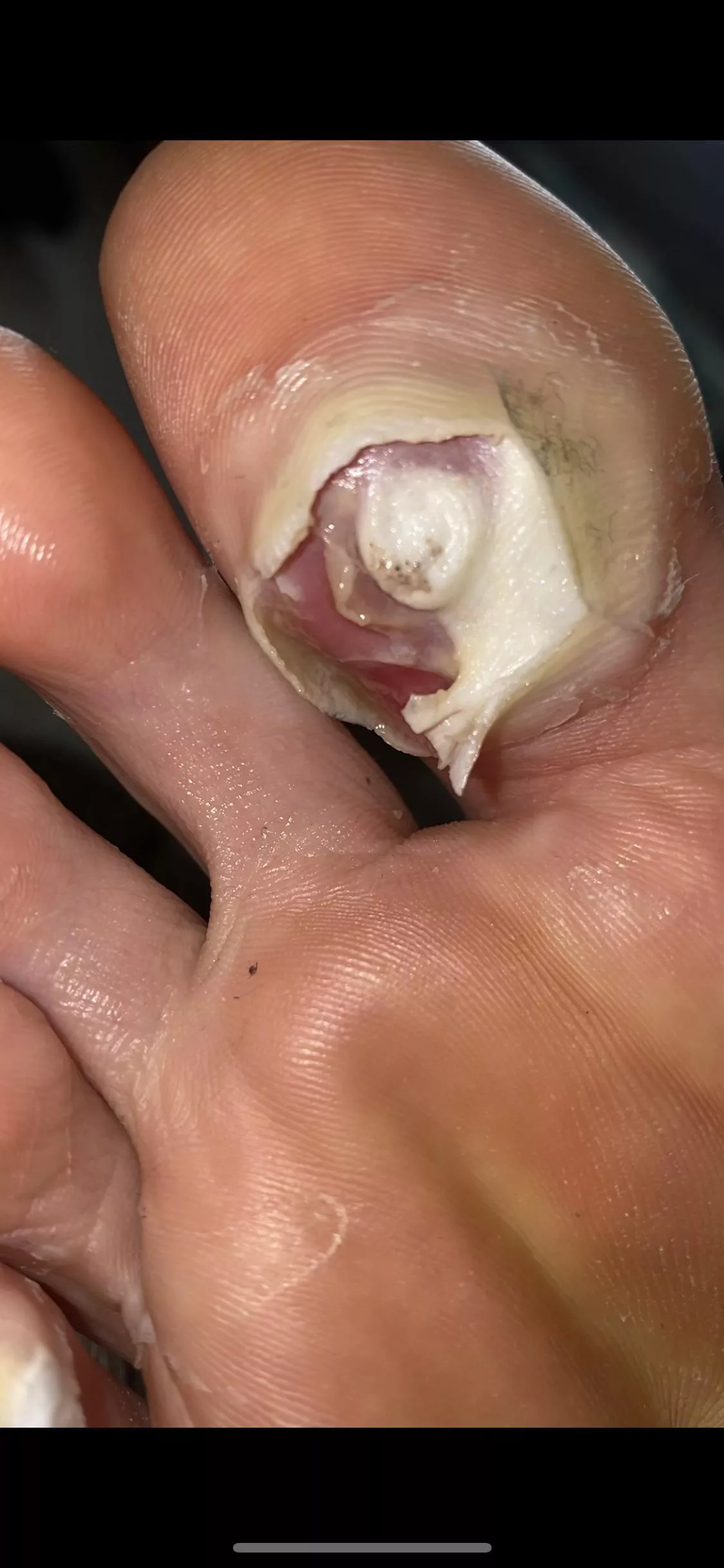 Plantar wart blister popper exposing the inner goodness of the raw wart - any ideas on how to proceed? posted by MartinMinkardo