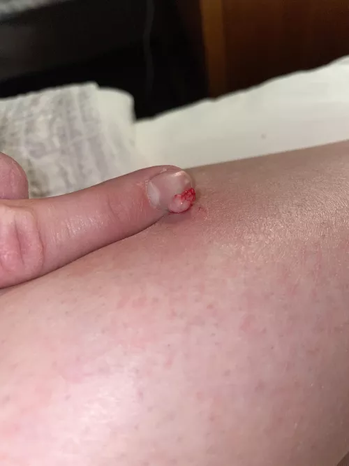 First half of the cyst my girlfriend had in her leg by pipercubsrcool