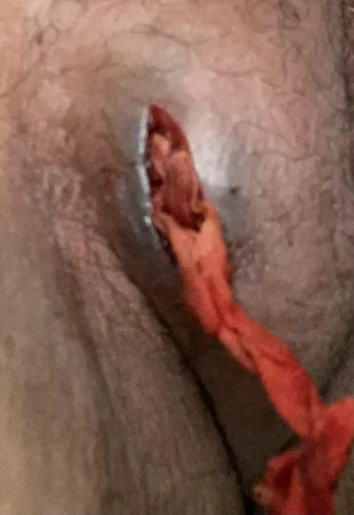 I post a month ago with a Bartholin cysts. It got drained that time but it came back Friday. This time this is what they did to drain it. They called it a Labia Abscess. by Sad-Engineering4157