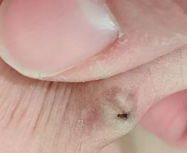 I was inserting old bellybutton piercing. As I was pushing it up from the bottom, this was coming out the top by FranniPants