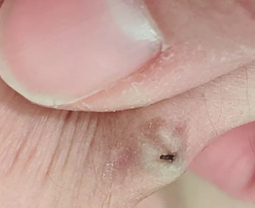 I was inserting old bellybutton piercing. As I was pushing it up from the bottom, this was coming out the top posted by FranniPants