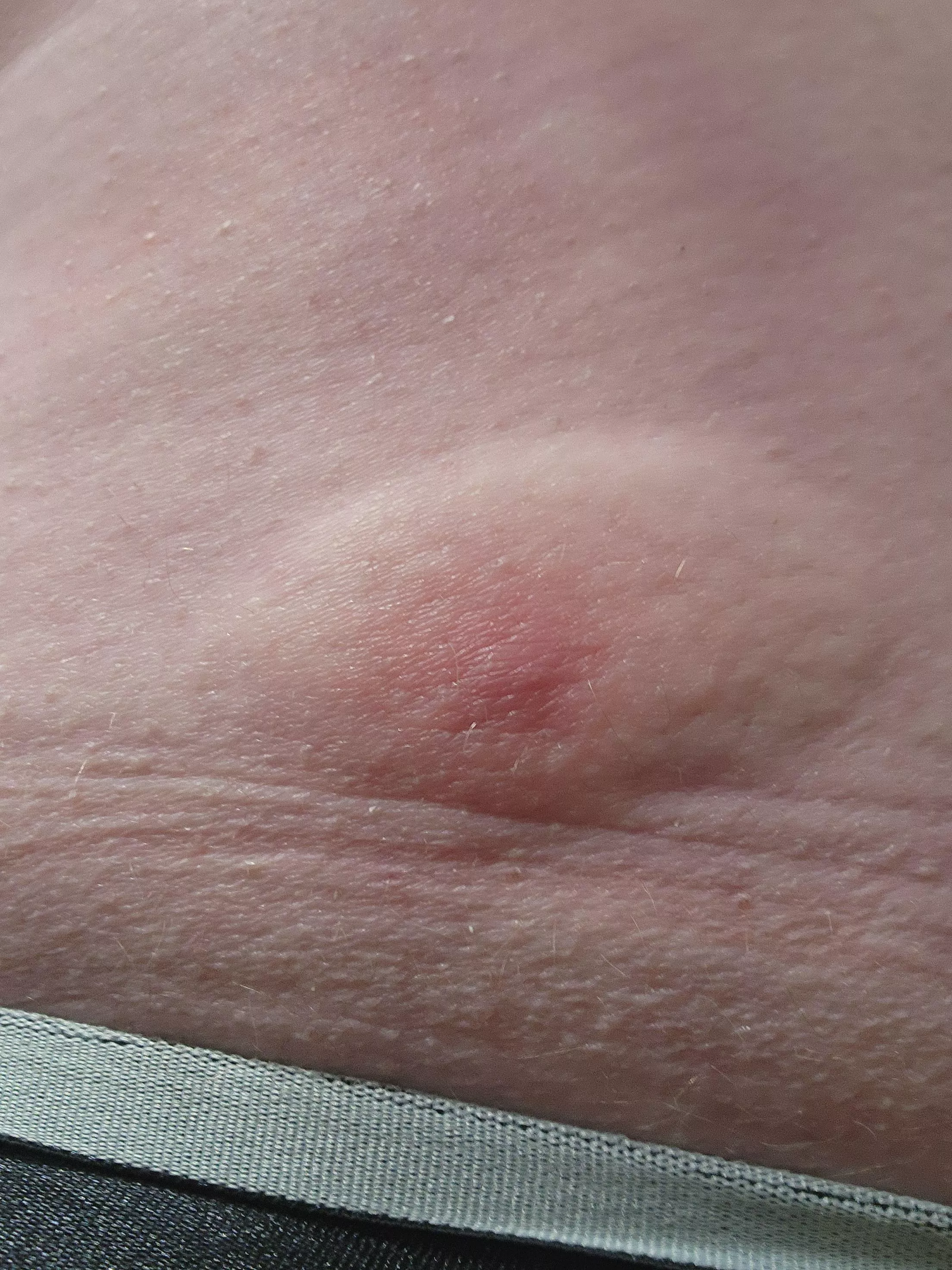 Well this popped up in under 6 hours. I've now got it circled with a time on it to make sure this doesn't get any bigger, but dang it is warm to the touch! This is right on my waist line, but I'll still mark NSFW for my boxers I guess posted by Essrysam