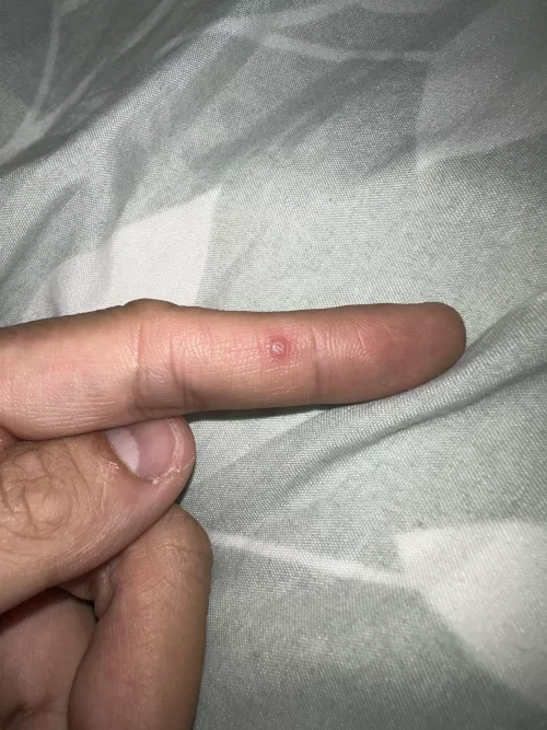 Please help me identify this tiny lesion on my index finger. Every time I put pressure on it there is a little discomfort. by Cifiriv