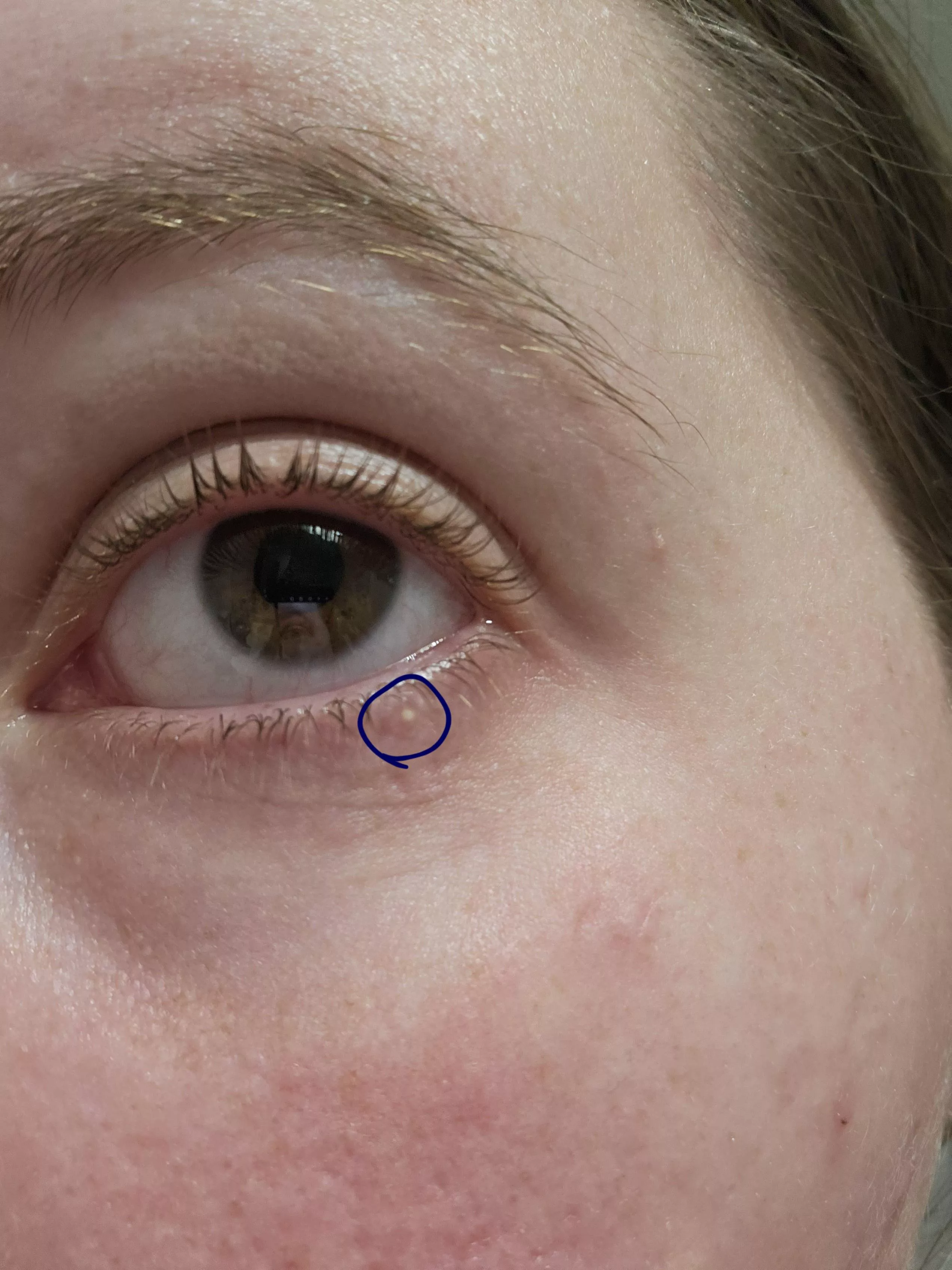 Was taking out contacts and noticed this Lil thing. Can't pop it cause the skin is too easy to maneuver. Will try to pop hopefully tmrw! posted by AriDreams