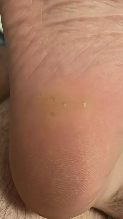 Bumps in my heel. What are they? Won’t pop. by kcfangaz
