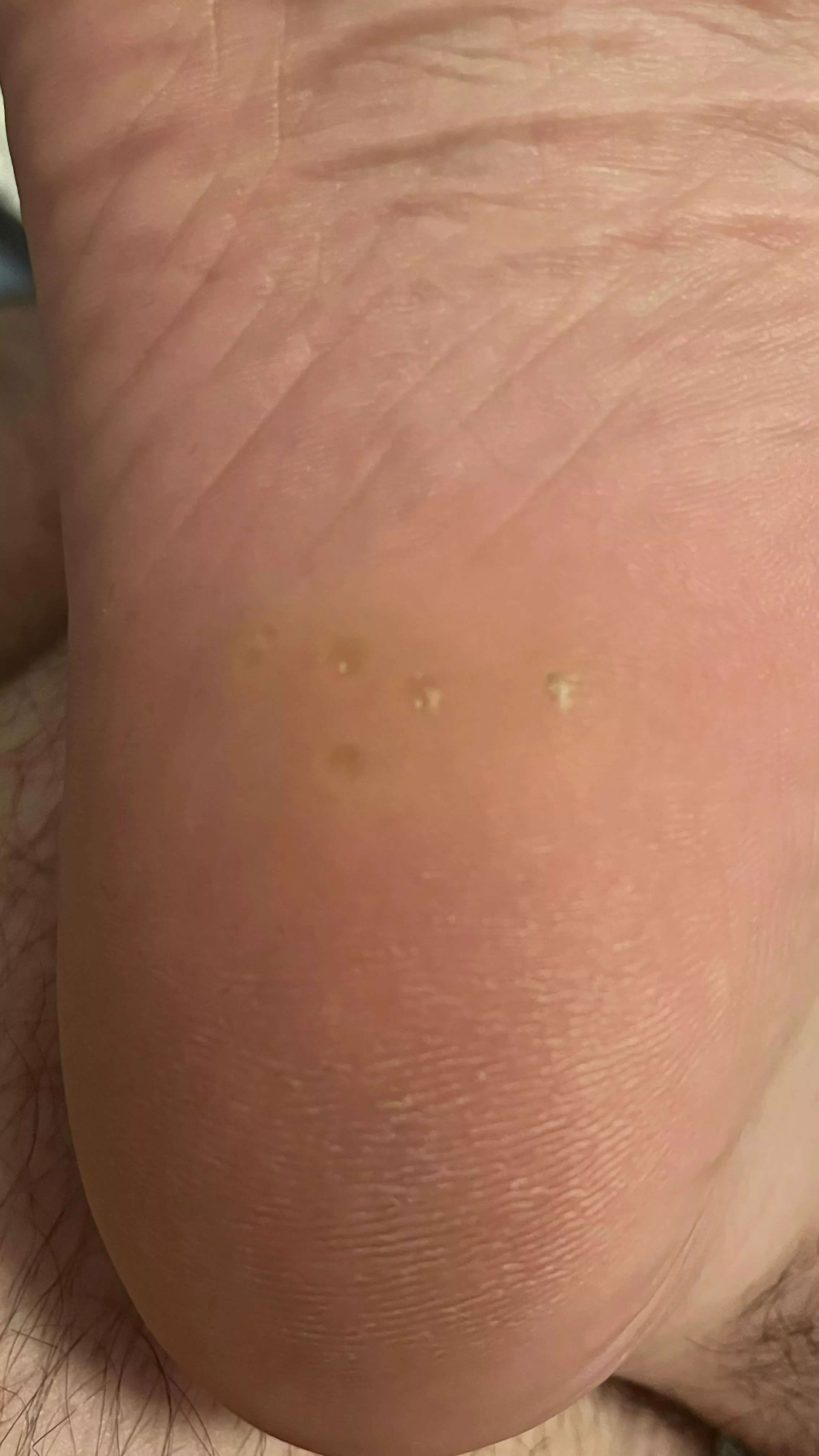 Bumps in my heel. What are they? Won’t pop. posted by kcfangaz