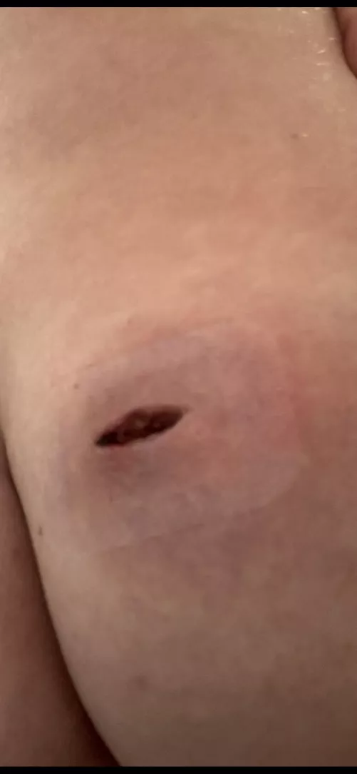Had an abscess drained two days ago on my butt cheek, prescribed oral antibiotics for 14 days. How long will a wound like this take to close? Not completely healed just closed up by Embarrassed-Quail926