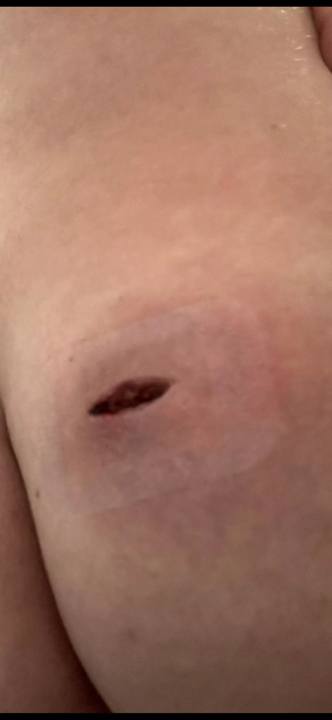 Had an abscess drained two days ago on my butt cheek, prescribed oral antibiotics for 14 days. How long will a wound like this take to close? Not completely healed just closed up posted by Embarrassed-Quail926