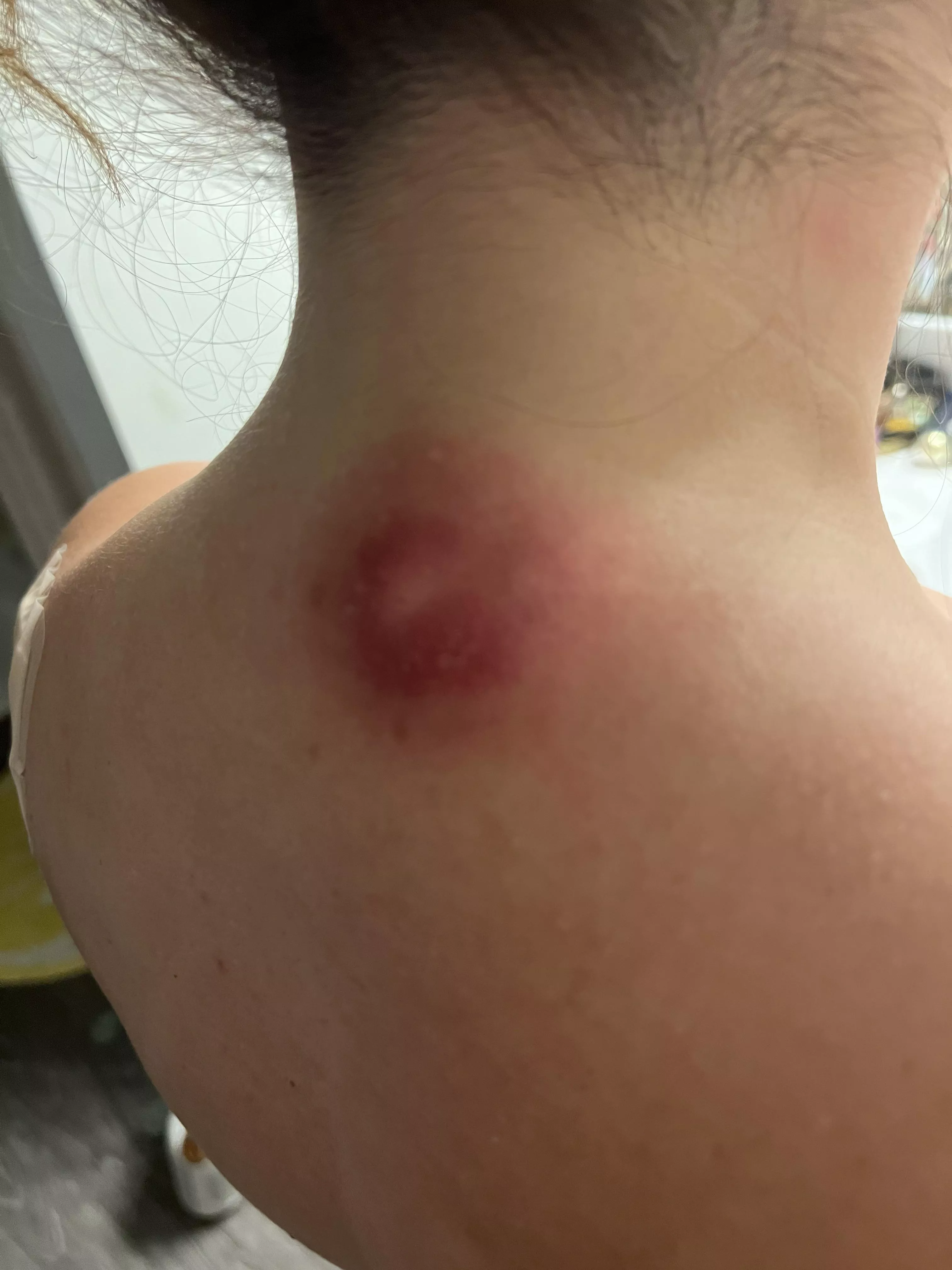 I have this cyst on the back of my neck and it is angry and keeps getting bigger. posted by sunrisedaydream
