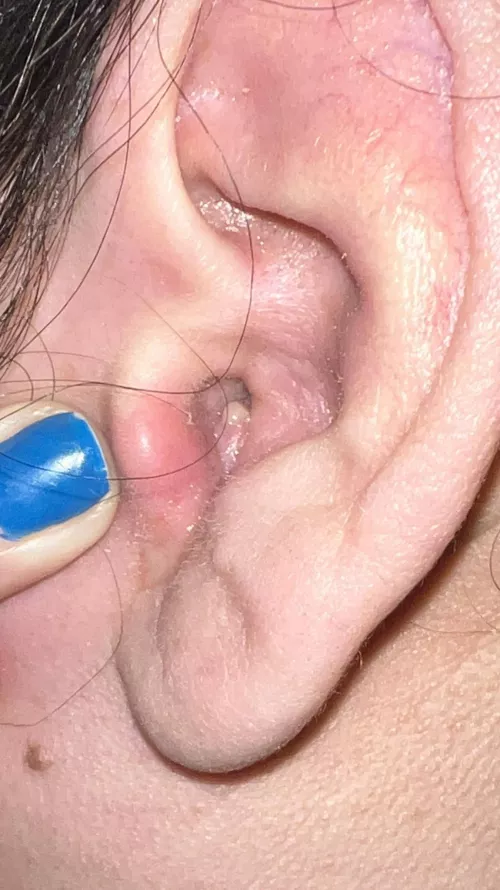 It’s so big I can’t hear! It came out of no where and it hurts so bad I can’t pop by pshhaww_