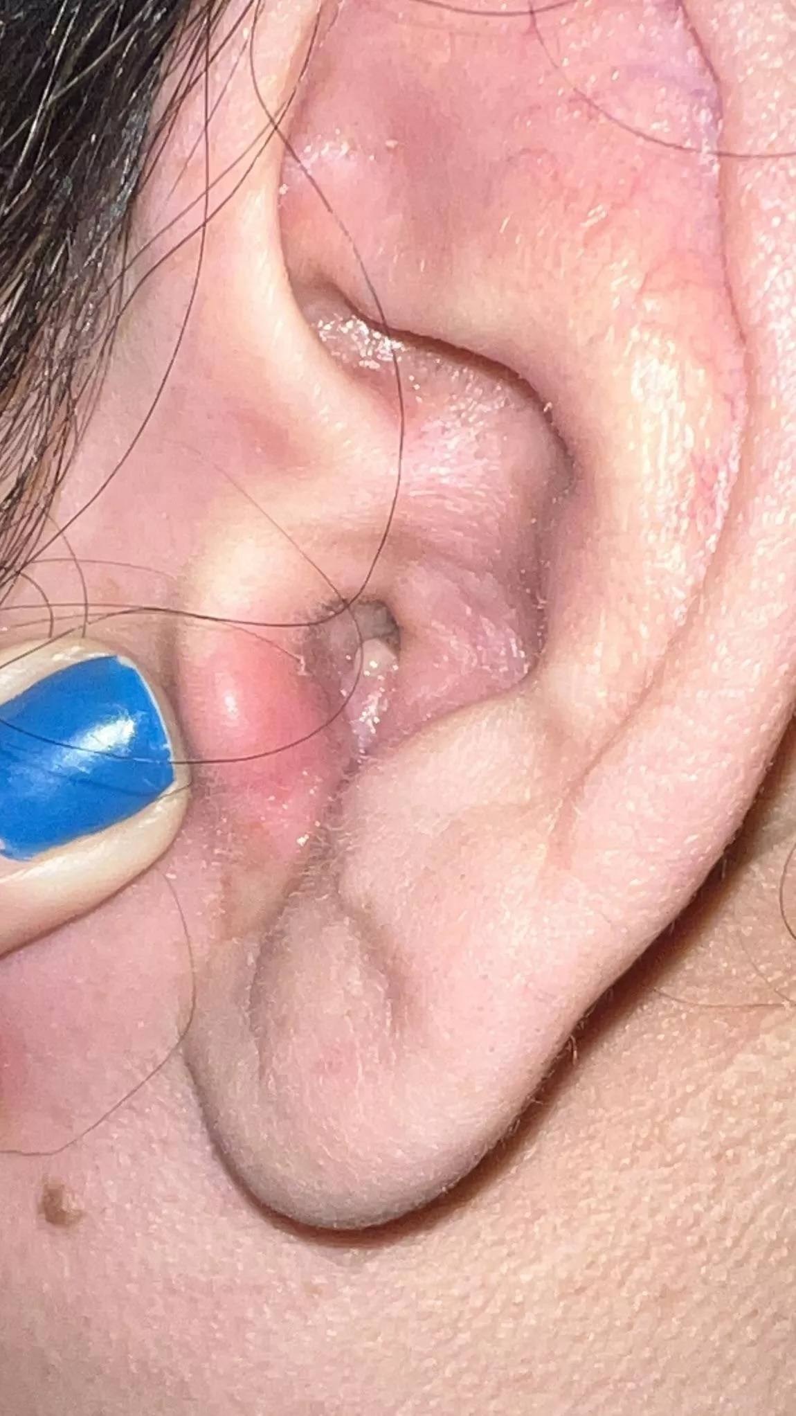 It’s so big I can’t hear! It came out of no where and it hurts so bad I can’t pop posted by pshhaww_